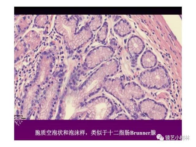 上消化道早癌病理的学习心得体会（附胃牵手癌的病例特点文献学习）