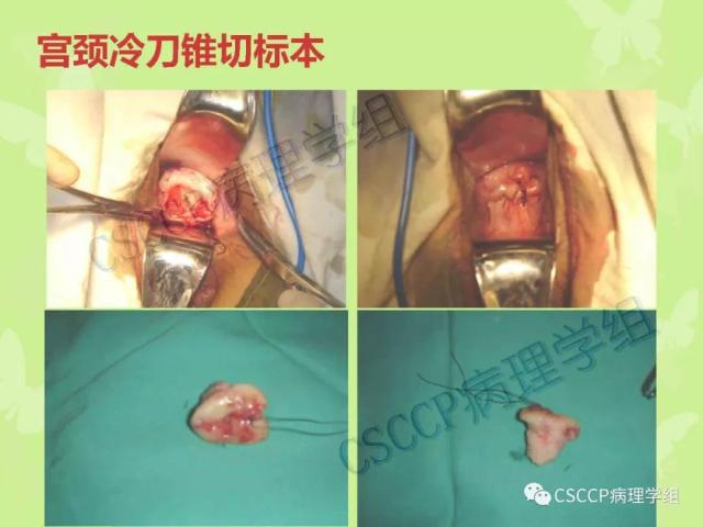 宫颈与子宫病变病理标本取材