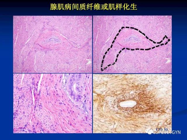 子宫内膜癌：诊断与进展