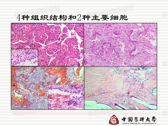 结合实际病例学习《硬化性肺细胞瘤的诊断陷阱》