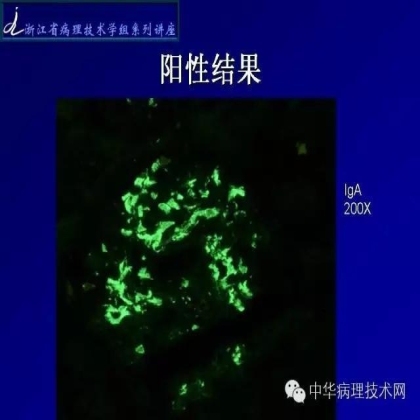 探讨免疫组织学在肾穿标本中的应用