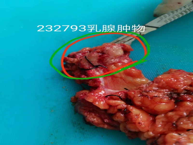 术中冰冻诊断有分歧的乳腺浸润性癌（九十）
