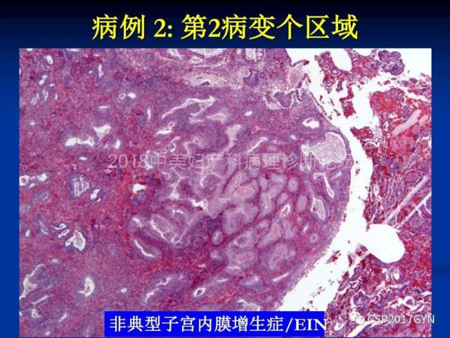 子宫内膜癌：诊断与进展