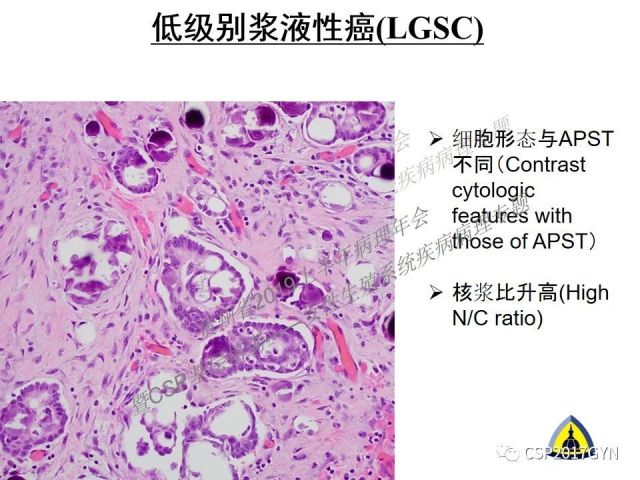 中华病理学会基层培训遵义站讲座（一）——卵巢和输卵管浆液性肿瘤的诊断和鉴别诊断