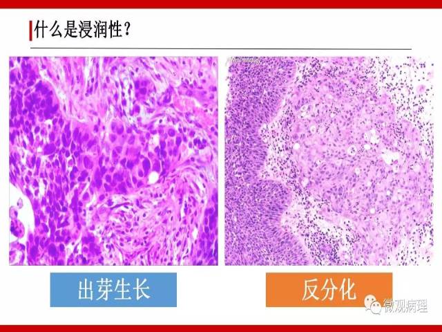 泌尿课程/浸润性尿路上皮癌病理学类型