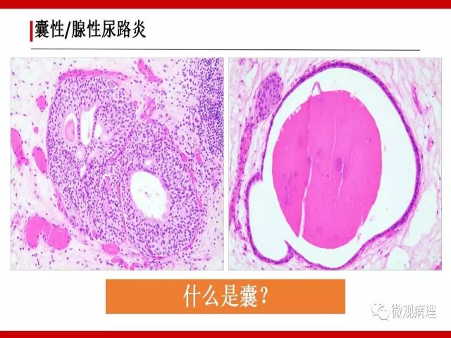 泌尿课程/尿路腺样病变的诊断要点