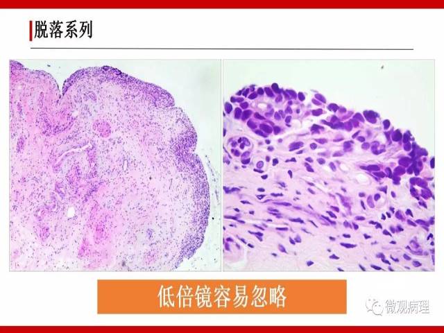 泌尿课程/非浸润性尿路上皮病变诊断的一些困惑