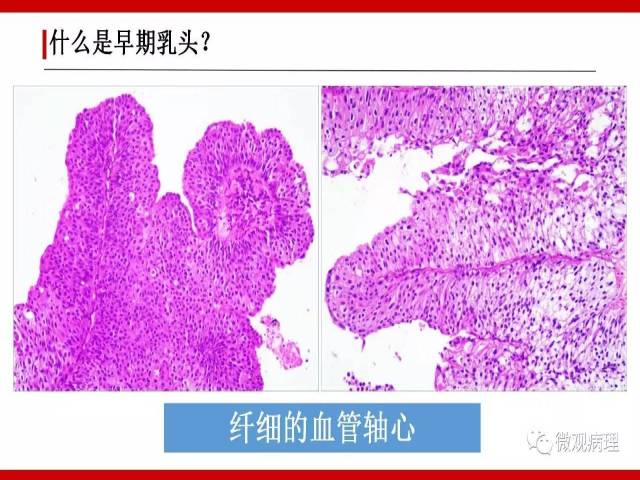 泌尿课程/尿路上皮病变的基本生长方式
