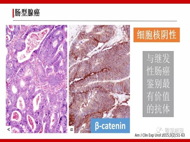 泌尿课程/尿路腺样病变的诊断要点