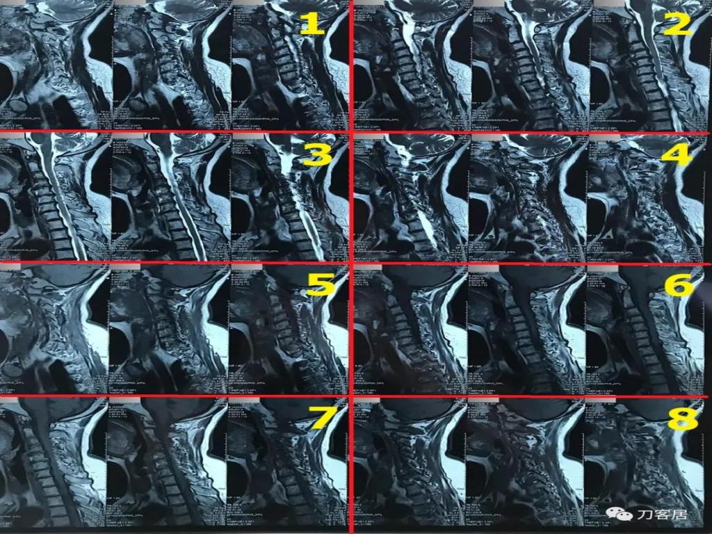 医生及患者通用:如何用手机翻拍X线片,磁共振片子,CT片子进行网络求医、病例讨论及保留资料 医生及患者通用:如何用手机翻拍X线片,磁共振片子,CT片子进行网络求医、病例讨论及保留资料