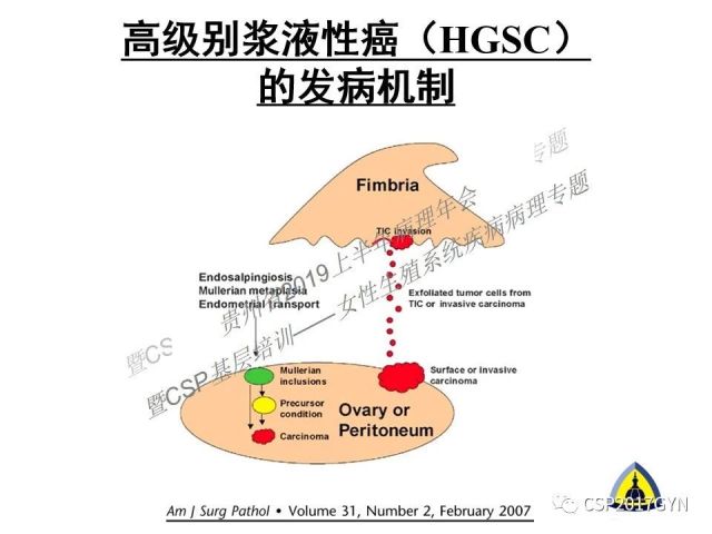 中华病理学会基层培训遵义站讲座（一）——卵巢和输卵管浆液性肿瘤的诊断和鉴别诊断