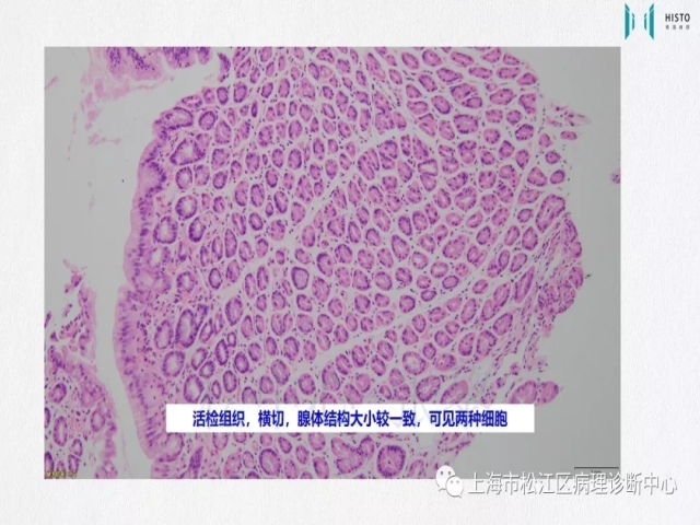 上消化道早癌病理诊断中的困惑及基本对策回顾