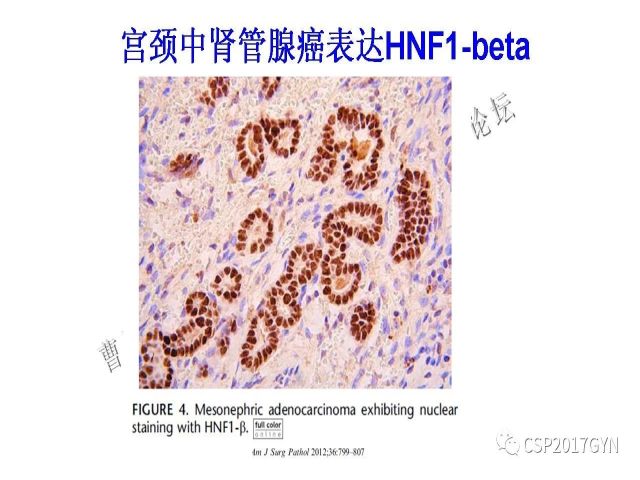 妇科肿瘤病理新进展——特殊类型的腺癌