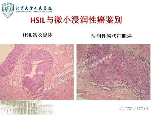 中华病理学会基层培训遵义站讲座（三）——宫颈鳞状上皮病变的病理诊断与鉴别诊断