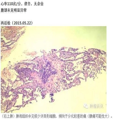中日韩个体化诊疗案例大赛经典赏析之十四——27岁晚期NSCLC，精准治疗 与 指南盲区向左向右