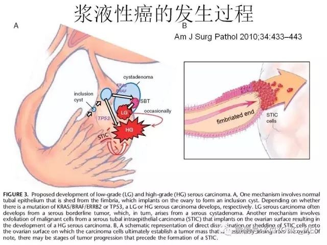 卵巢癌的病理诊断新进展（一）