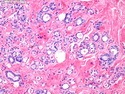 乳腺病理-乳腺良性增生-微腺性腺病