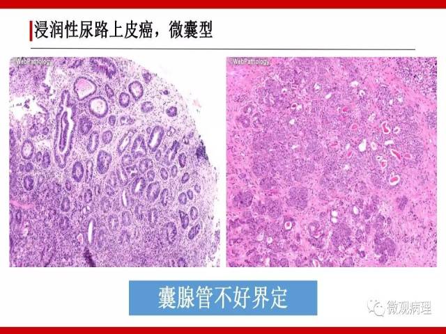 泌尿课程/浸润性尿路上皮癌病理学类型
