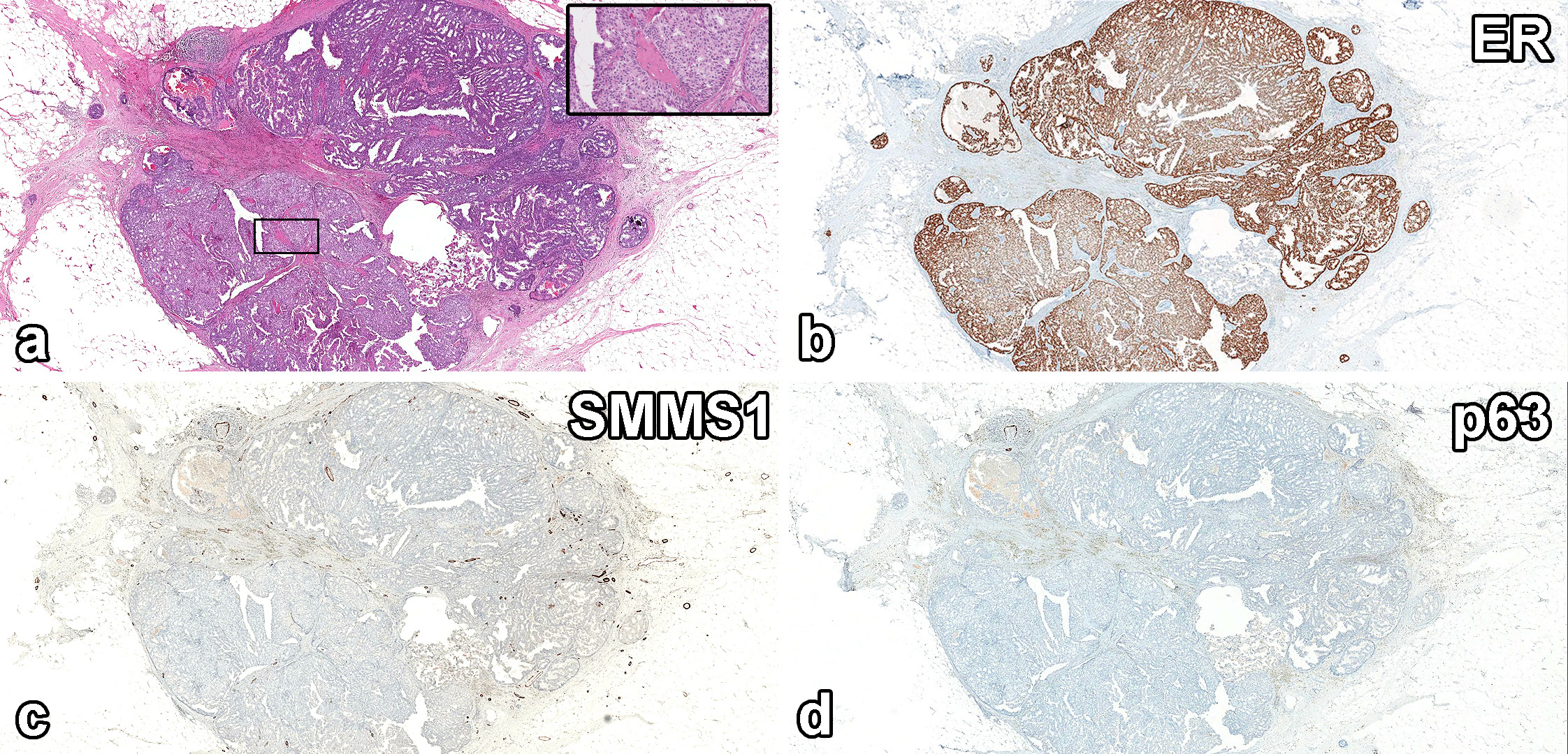 读文献，学病理-乳腺乳头状肿瘤难点总结（二）