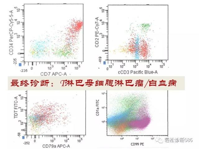 淋巴母细胞淋巴瘤
