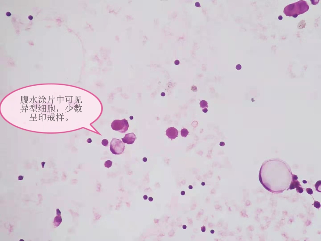 腹水转移癌，未找到原发灶——病理科工作札记（五十六）