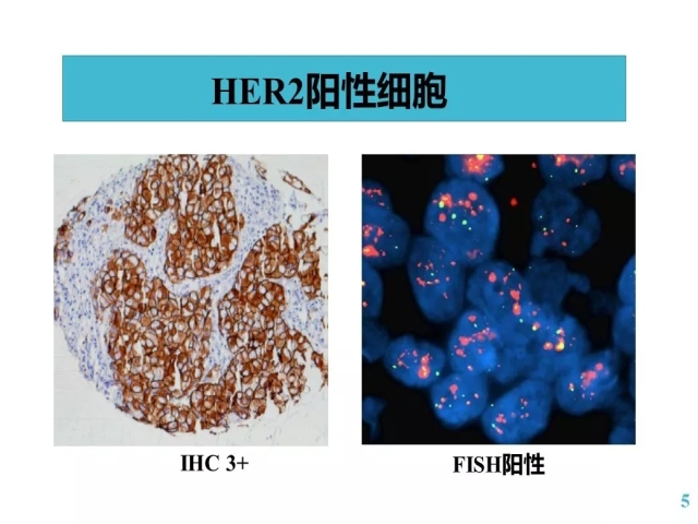 乳腺癌HER2检测指南更新