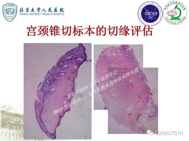 中华病理学会基层培训遵义站讲座（三）——宫颈鳞状上皮病变的病理诊断与鉴别诊断