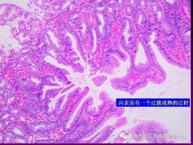 上消化道低级别上皮内瘤变的那些事