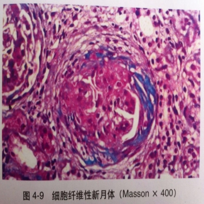 硅结节和新月体形成的病理变化
