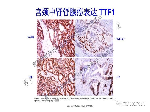 妇科肿瘤病理新进展——特殊类型的腺癌