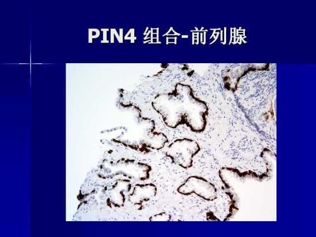 前列腺病理诊断线索（上）——黄教悌