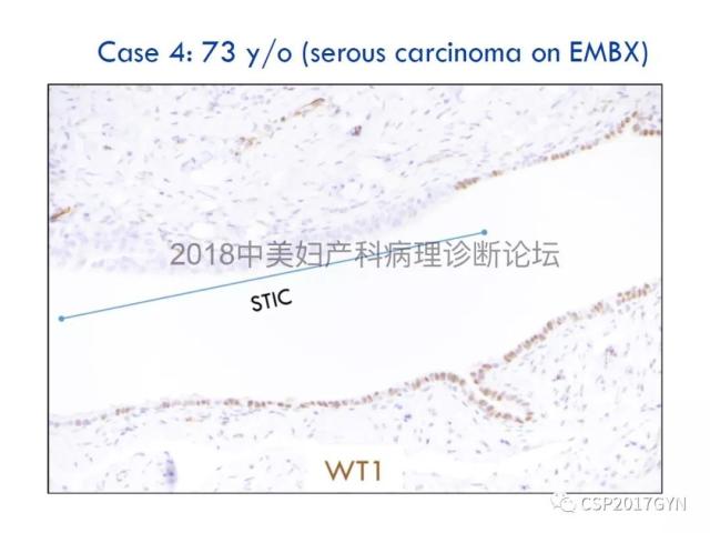 女性生殖道发育