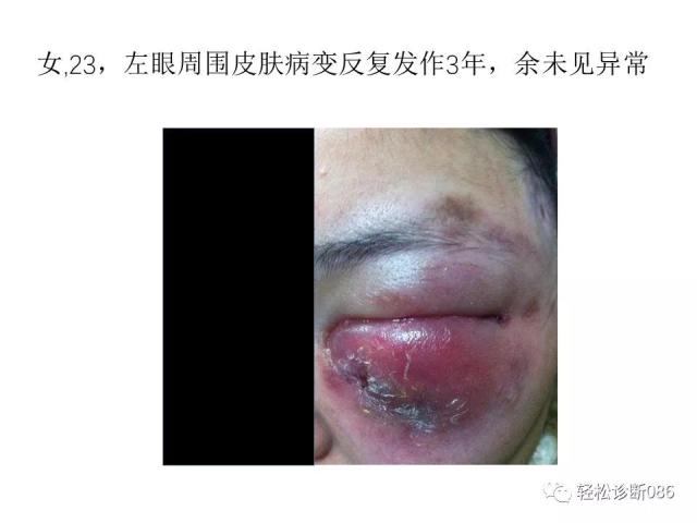 皮肤T细胞淋巴瘤