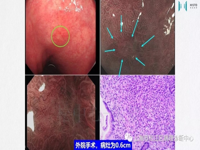 上消化道早癌病理诊断中的困惑及基本对策回顾