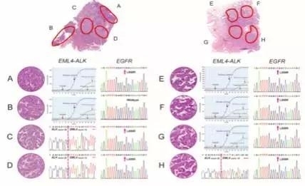 【JCO】ALK阳性和ALK/ EGFR双突变肺腺癌瘤内异质性重大研究发现