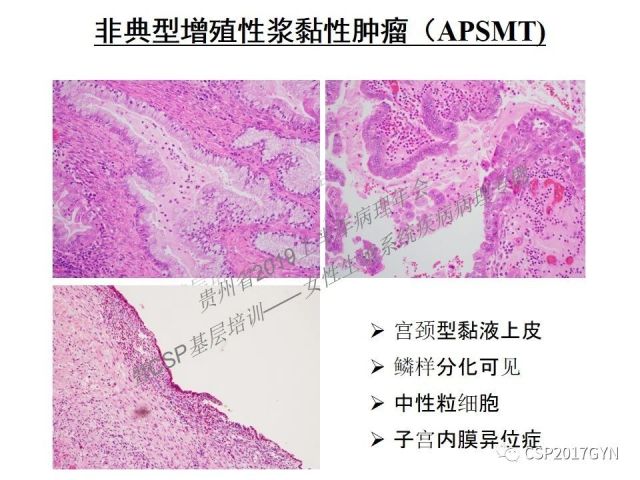 中华病理学会基层培训遵义站讲座（一）——卵巢和输卵管浆液性肿瘤的诊断和鉴别诊断