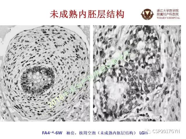 卵巢畸胎瘤诊断难点