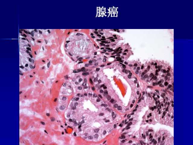 前列腺病理诊断线索（上）——黄教悌