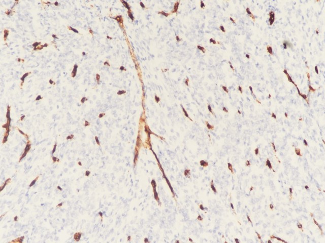 肾透明细胞肉瘤的临床病理学特征