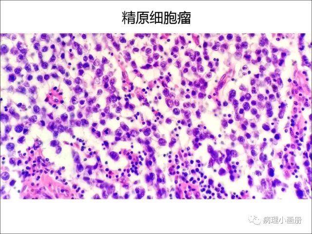 泌尿病理--精原细胞瘤VS精母细胞瘤