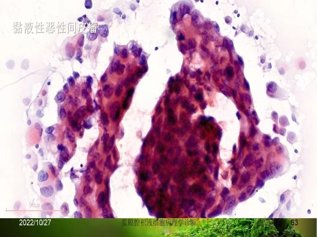 直播预告 | 今晚8点，马博文老师将为大家带来：《浆膜腔 积液细胞病理学诊断》，敬请期待！