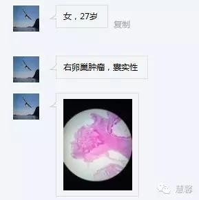 卵巢畸胎瘤，成熟或未成熟性？（曾丽霞分享病例，孔祥田(Max)*Roswell*NM老师讲解）