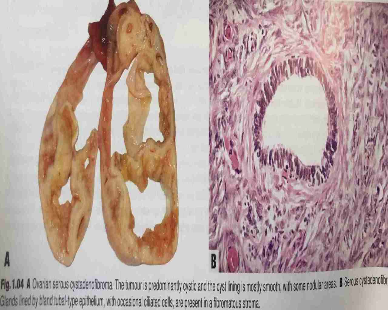 WHO肿瘤分类第5版-女性生殖学习笔记3 卵巢浆液性囊腺瘤、腺纤维瘤和表面乳头状瘤