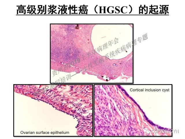 中华病理学会基层培训遵义站讲座（一）——卵巢和输卵管浆液性肿瘤的诊断和鉴别诊断