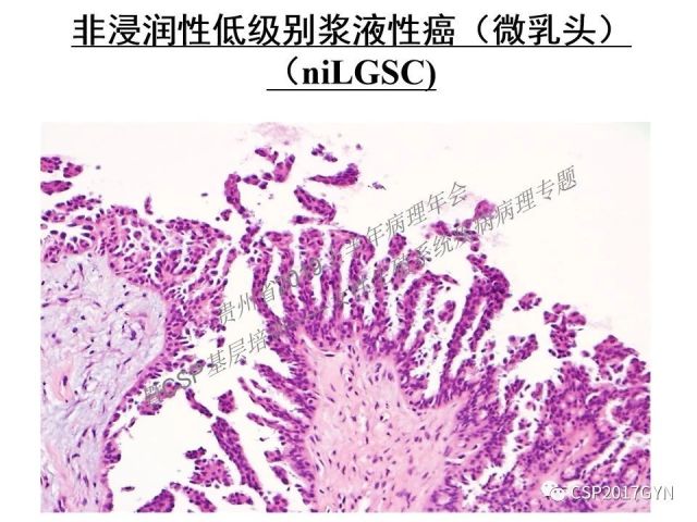 中华病理学会基层培训遵义站讲座（一）——卵巢和输卵管浆液性肿瘤的诊断和鉴别诊断