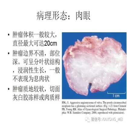 女性生殖道软组织肿瘤病理诊断及进展（二）