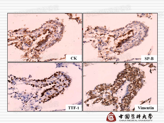 结合实际病例学习《硬化性肺细胞瘤的诊断陷阱》