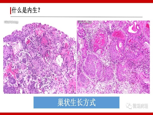 泌尿课程/尿路上皮病变的基本生长方式