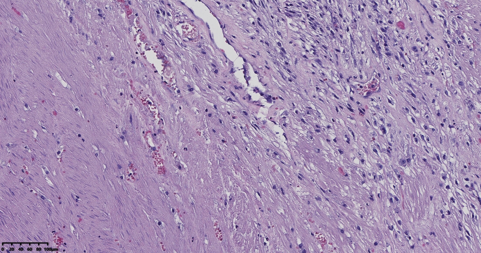 子宫多发性平滑肌瘤伴肉瘤