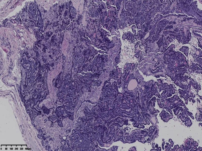 这个甲状腺肿瘤怎么看？